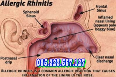 Penyakit Rhinitis